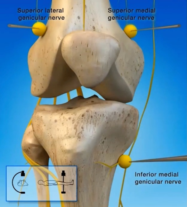 COOLIEF COOLIEF® Cooled Radiofrequency Treatment Perth